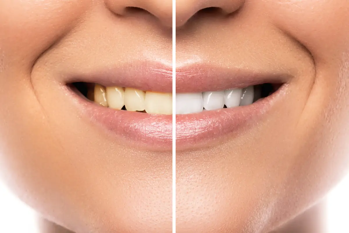 Estética Dental